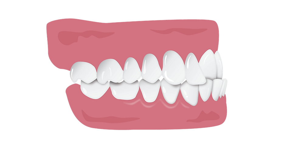 Articulé-croisé - Cross bite