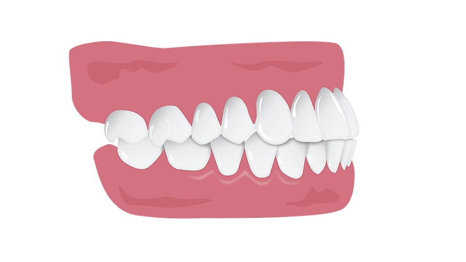 Illustration d’un bout-à-bout incisif (malocclusion)