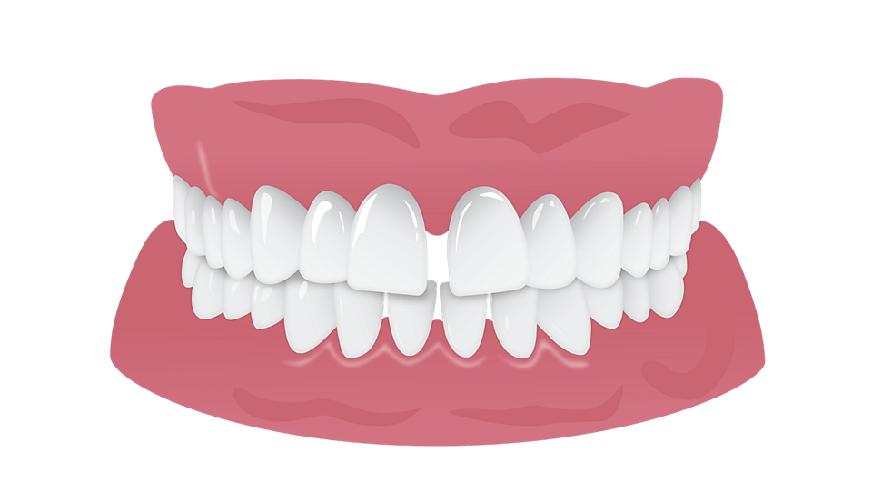 Diastème (Spacing) Malocclusion