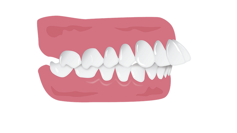 illustration d'un surplomb incisif