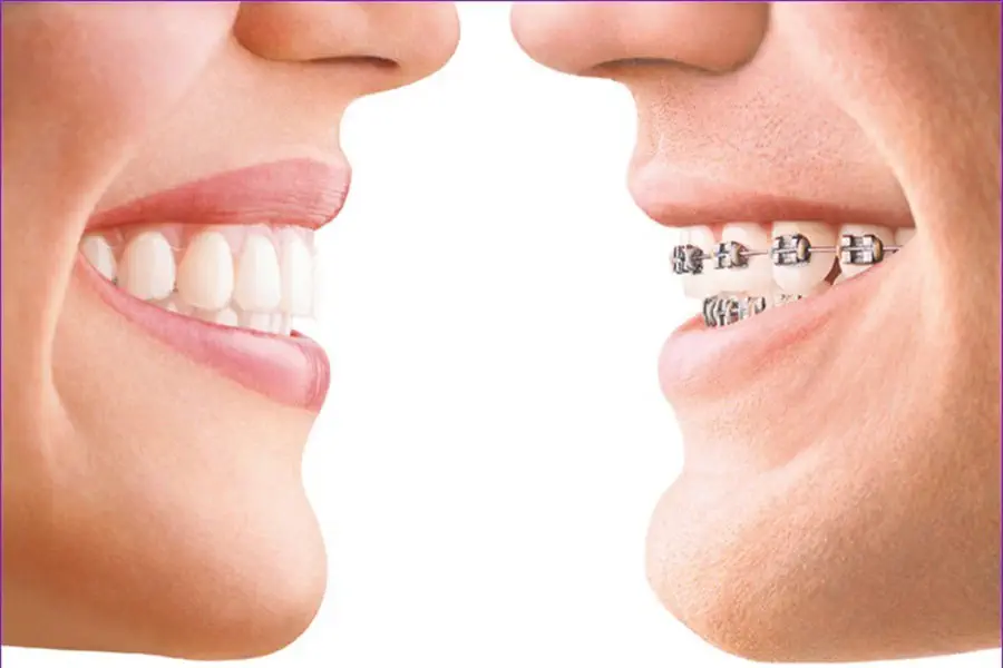 Orthodontie amovible
