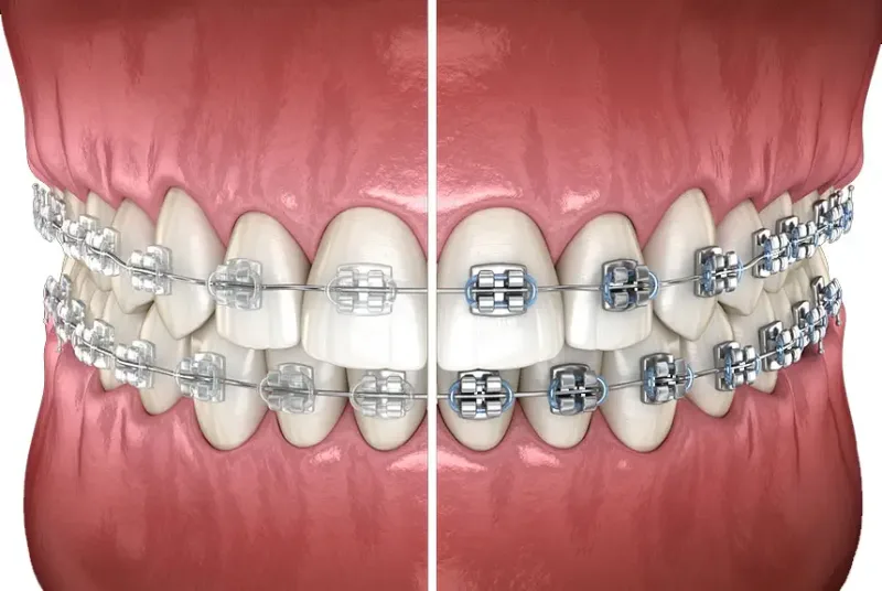 Metalceramicbraces 800x536