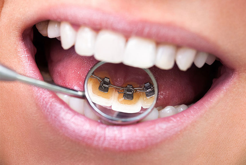 orthodontie adultes bruxelles